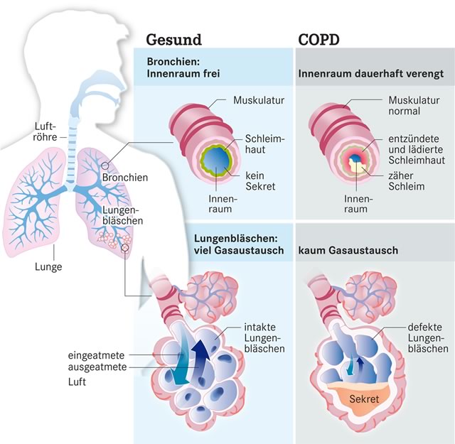 La storia naturale della BPCO